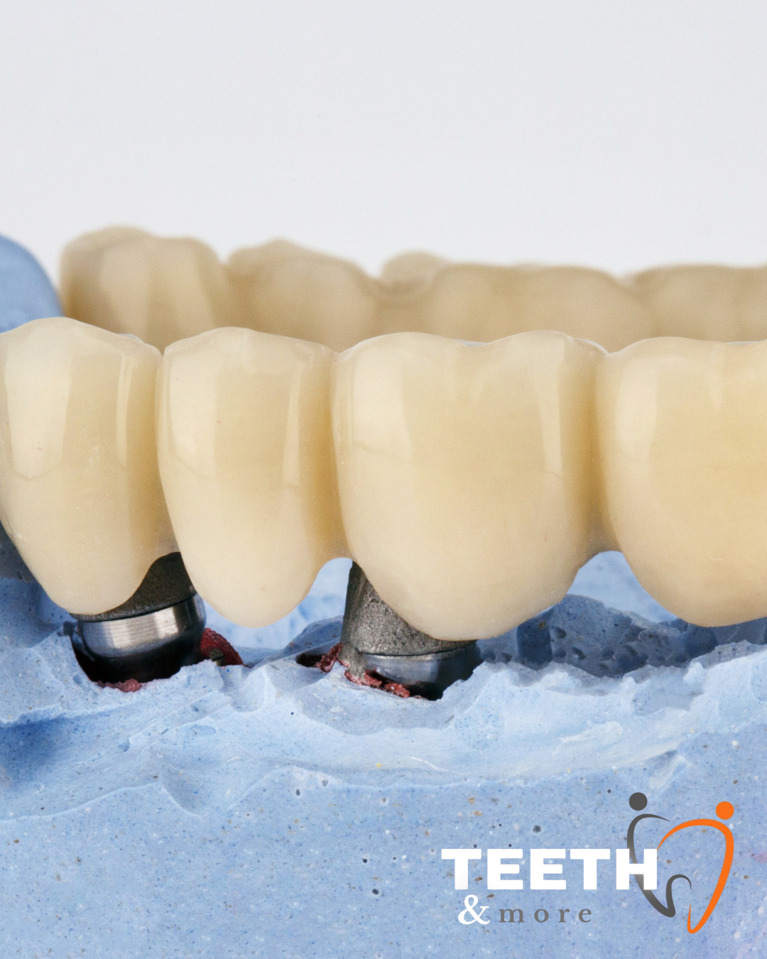 Dental Bridge in south Delhi , dentist in south delhi , dental clinic in south delhi