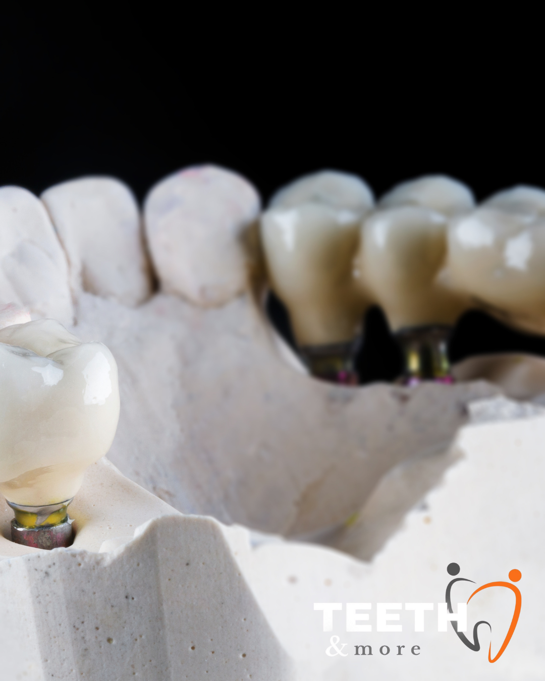 Dental Bridge in south Delhi , dentist in south delhi , dental clinic in south delhi