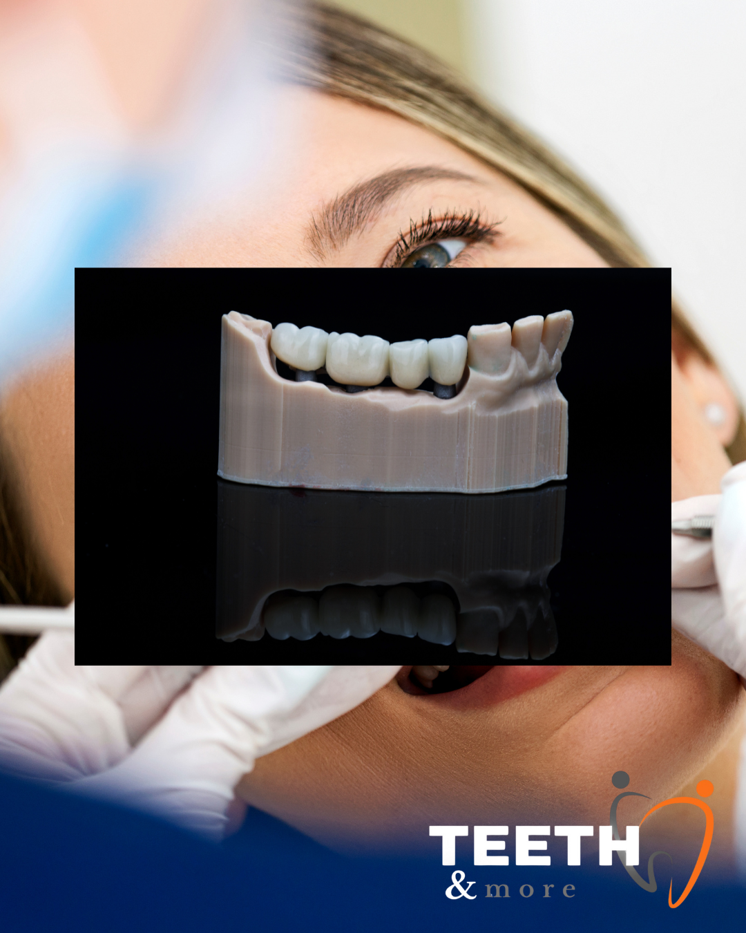 Dental Bridge in south Delhi , dentist in south delhi , dental clinic in south delhi