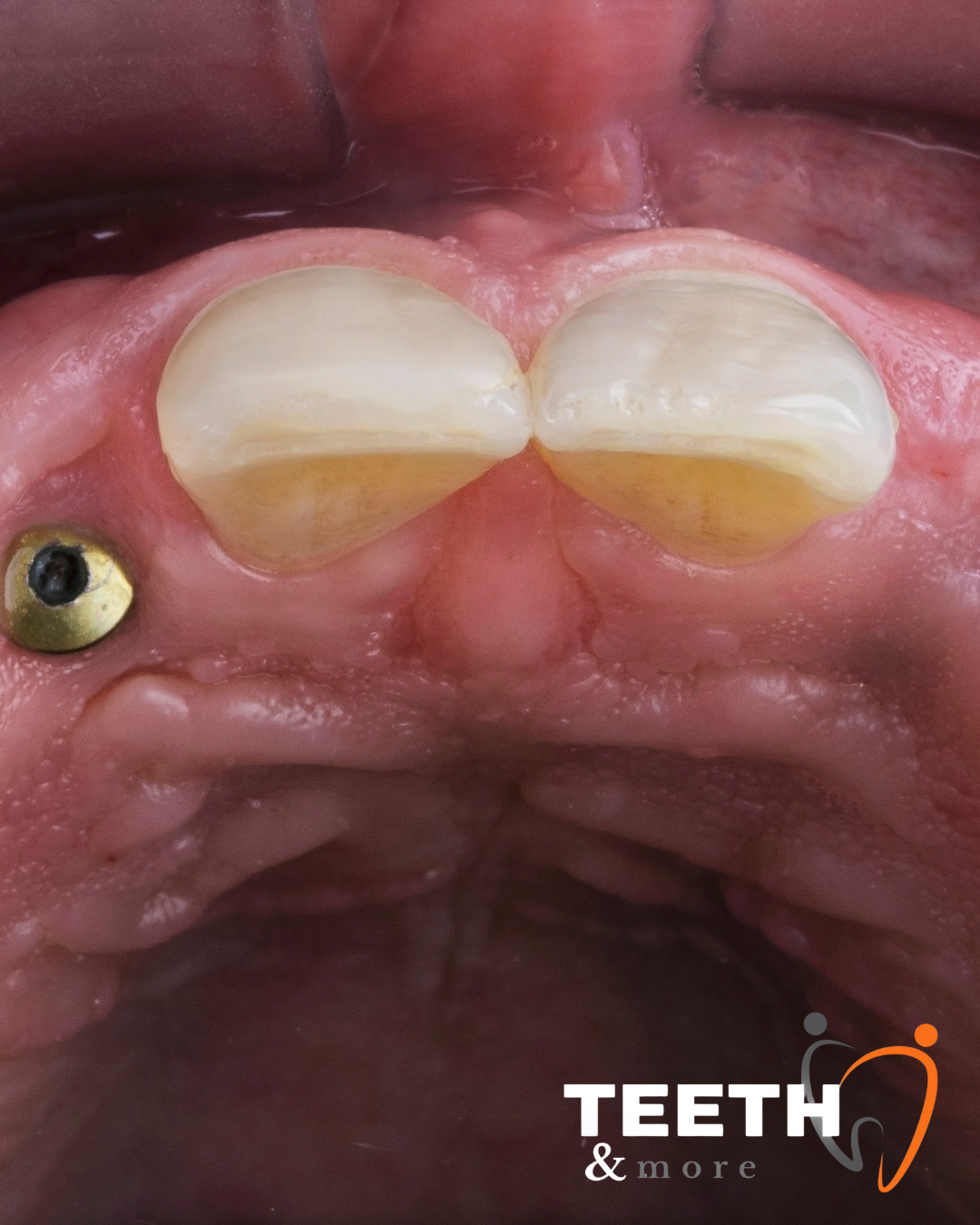 Dental Bridge in south Delhi , dentist in south delhi , dental clinic in south delhi