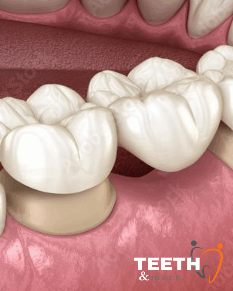 dental crowns clinic in South Delhi, dentist in south delhi , dental clinic in south delhi