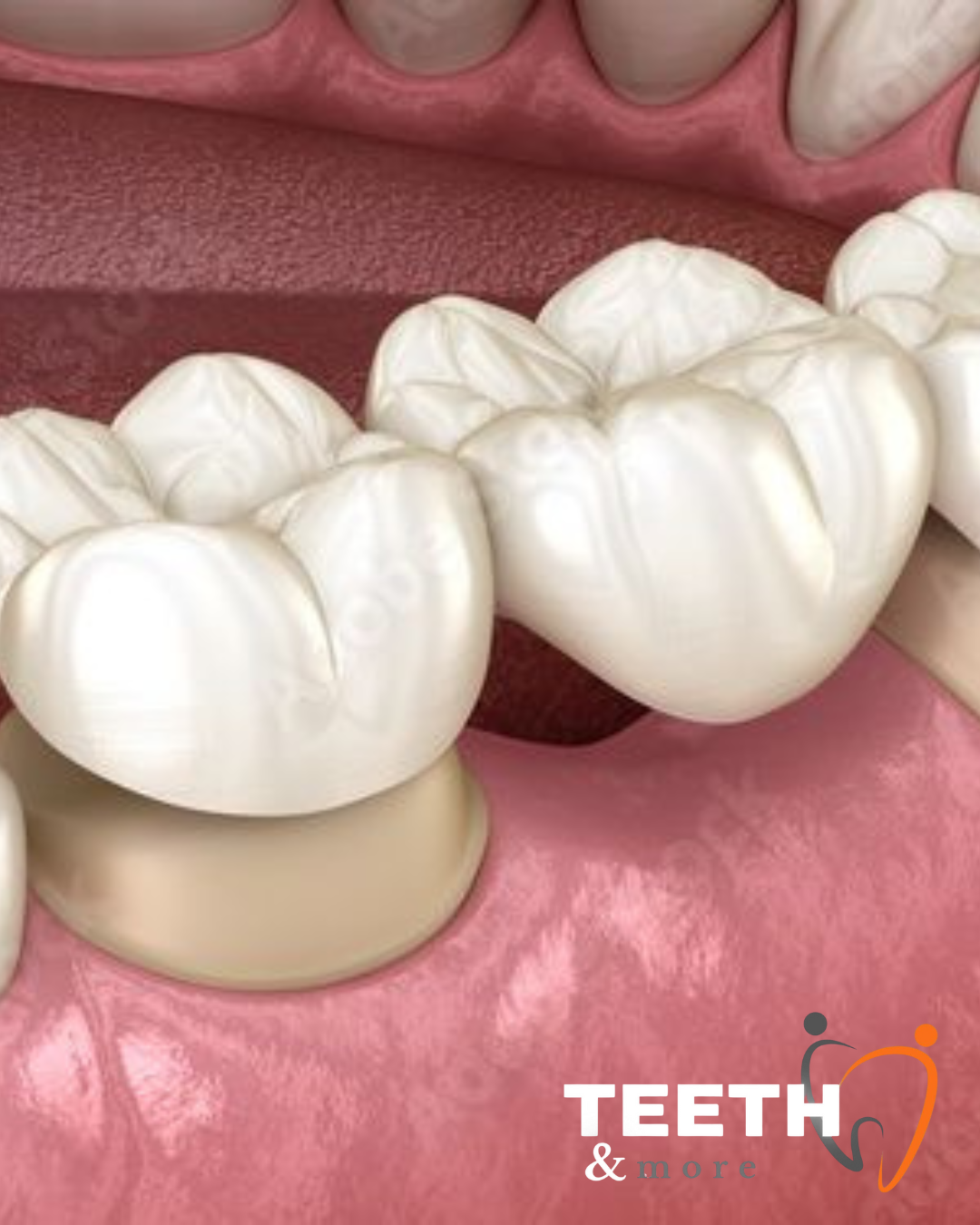 dental crowns clinic in South Delhi, dentist in south delhi , dental clinic in south delhi