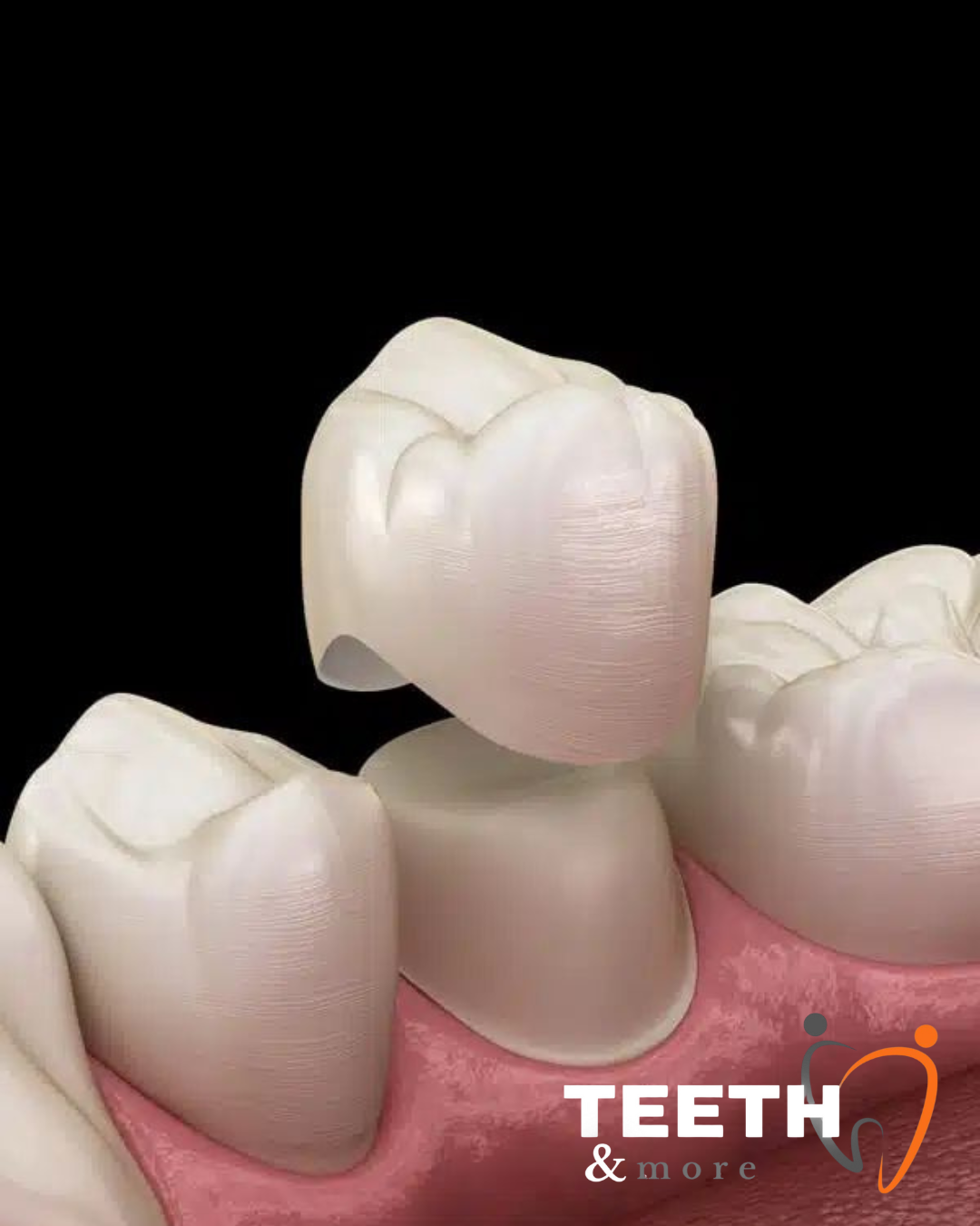 dental crowns clinic in South Delhi, dentist in south delhi , dental clinic in south delhi