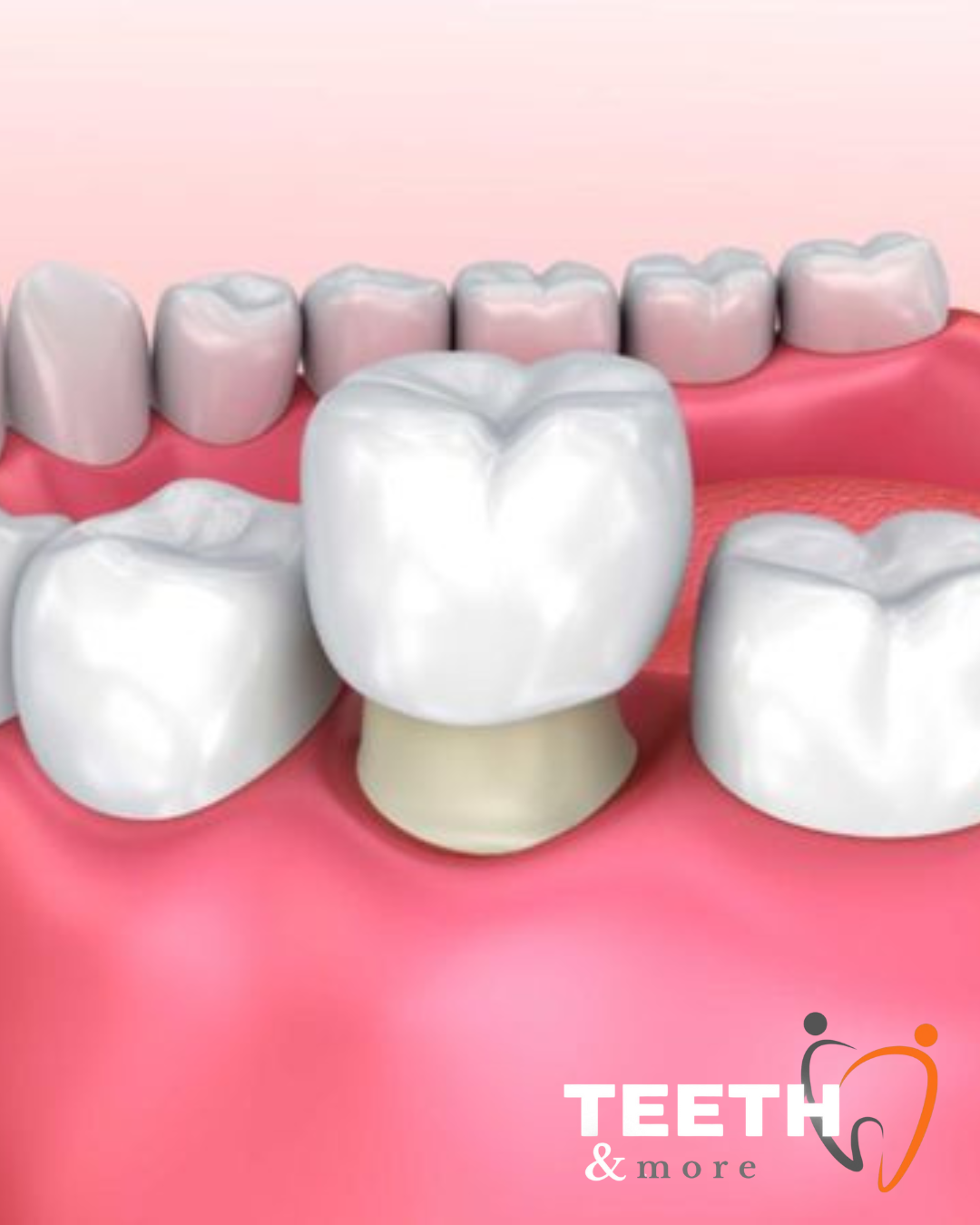 dental crowns clinic in South Delhi, dentist in south delhi , dental clinic in south delhi