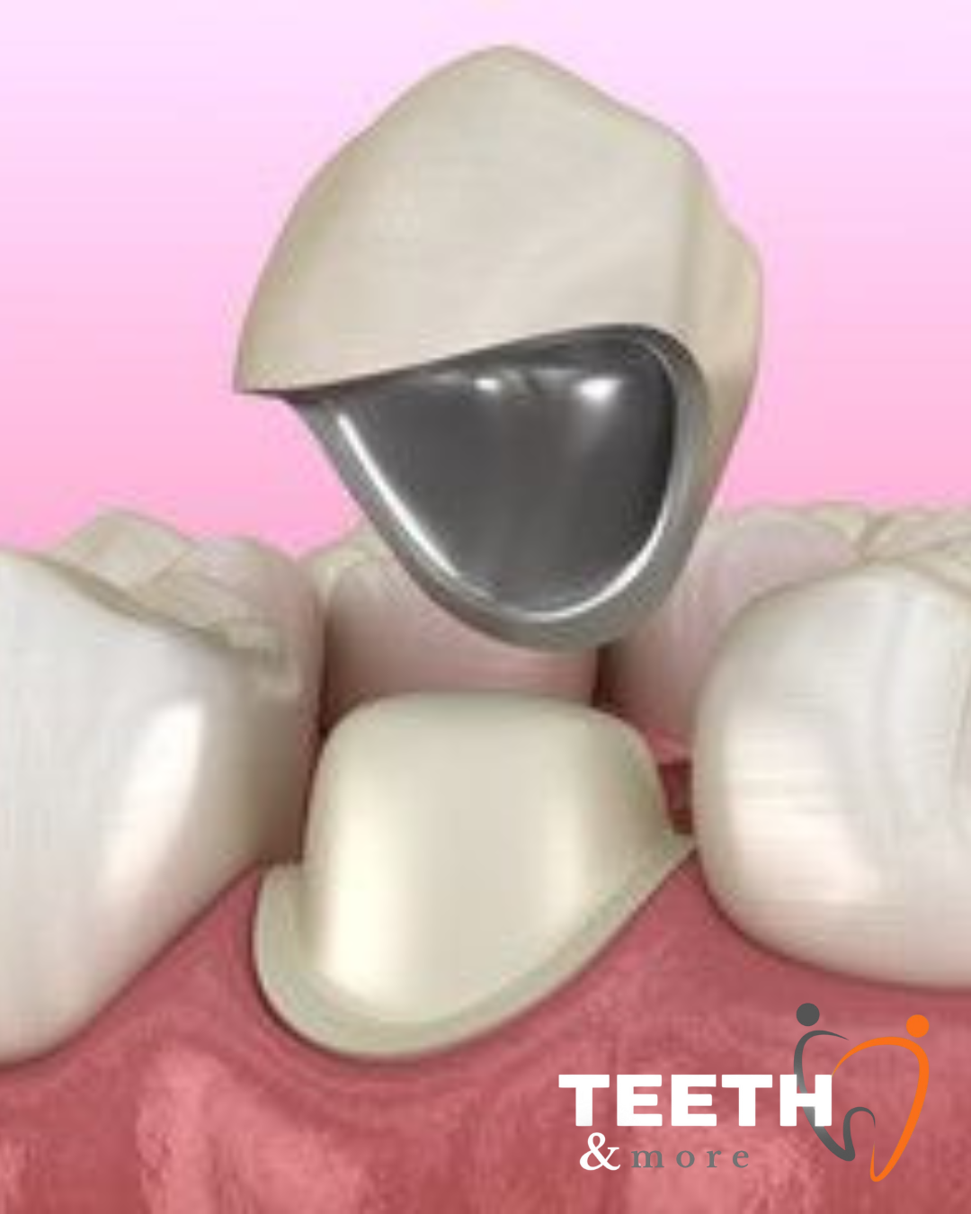 dental crowns clinic in South Delhi, dentist in south delhi , dental clinic in south delhi