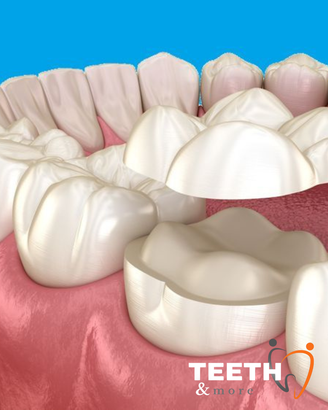 dental crowns clinic in South Delhi, dentist in south delhi , dental clinic in south delhi
