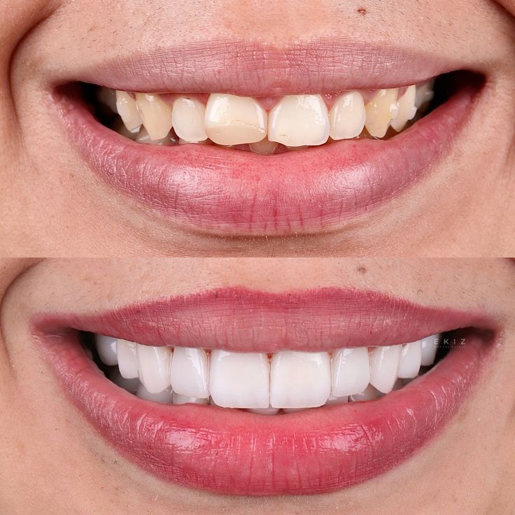 root-canal-vs-extraction-comparison