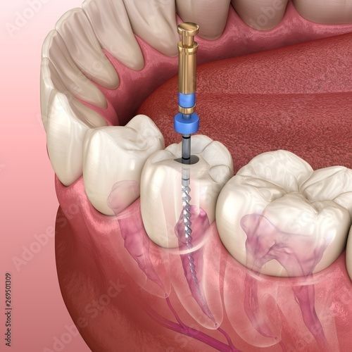 Root Canal vs Extraction comparison