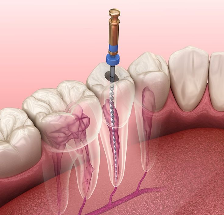 Root Canal vs Extraction comparison