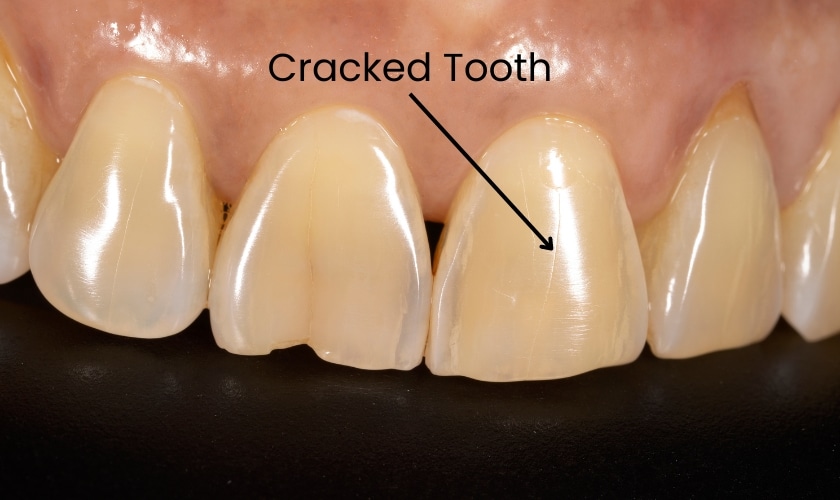 Tooth Extraction vs Root Canal