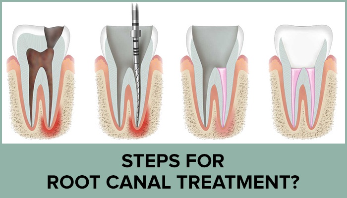 Tooth Extraction vs Root Canal